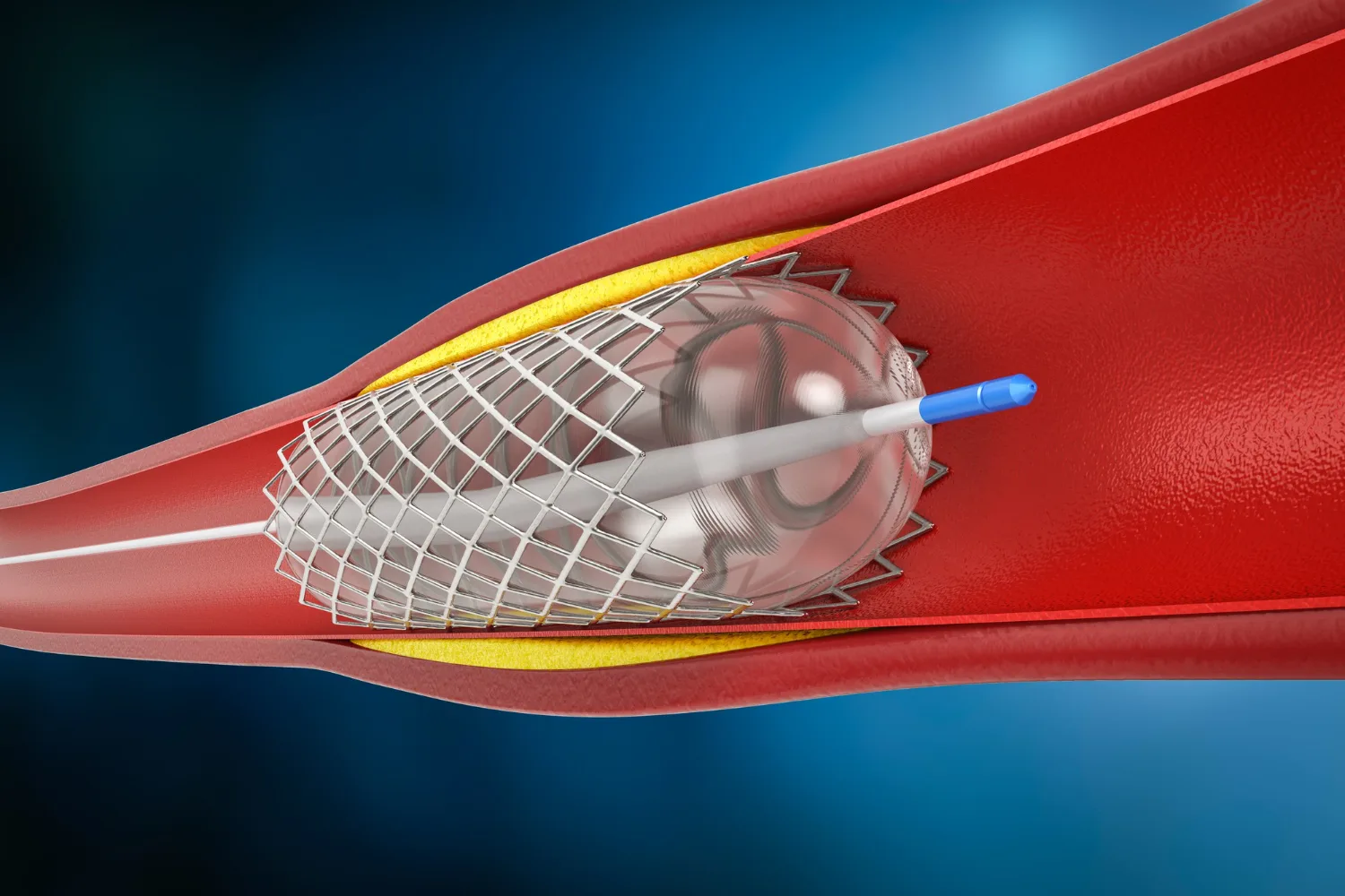 Angioplastia coronaria en CDMX: Recupera la salud de tu corazón con el mejor cuidado